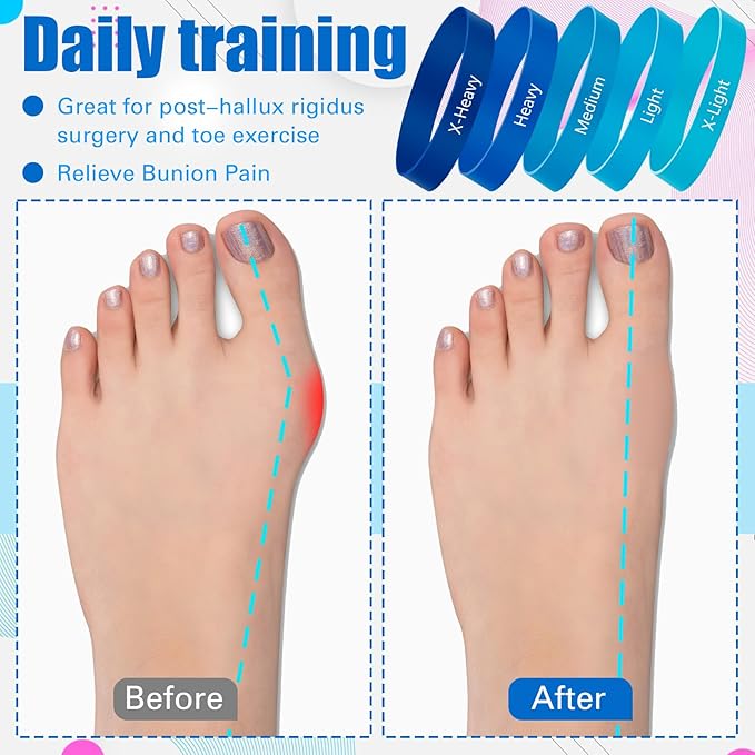 Set of 5 Toe Stretcher Band Separator Spacer Bunion Correction Hallux Valgus Alignment Foot Stretcher Straightener Resistance Loop Yoga Exercise Foot Care with Carry Bag(Blue)