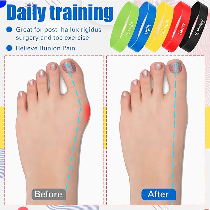 Set of 5 Toe Stretcher Band Separator Spacer Bunion Correction Hallux Valgus Alignment Foot Stretcher Straightener Resistance Loop Yoga Exercise Foot Care with Carry Bag(Multicolor)