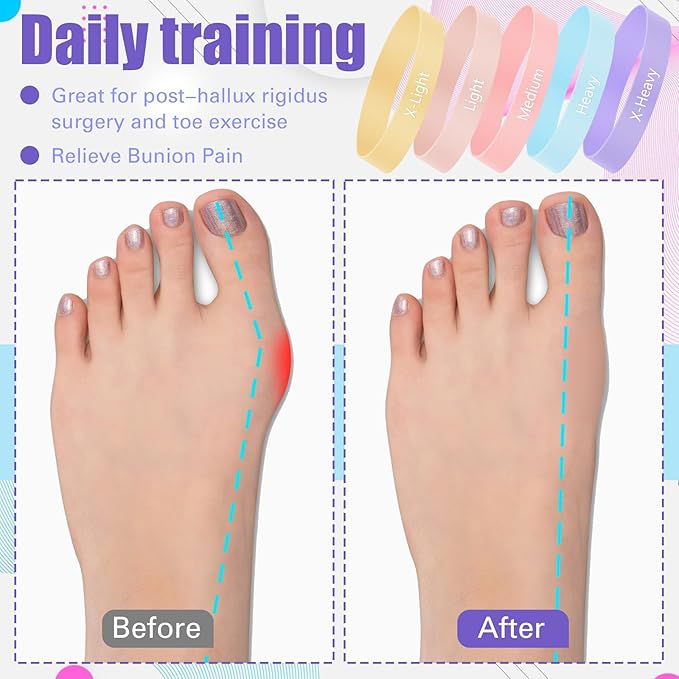 Set of 5 Toe Stretcher Band Separator Spacer Bunion Correction Hallux Valgus Alignment Foot Stretcher Straightener Resistance Loop Yoga Exercise Foot Care with Carry Bag(Pastel)
